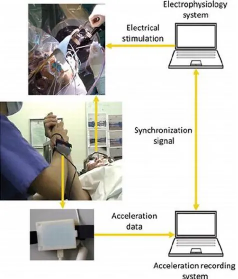 FIGURE  1.  Data  recording  setup  used  to  assist  rigidity  evaluations  performed  during  DBS  surgery