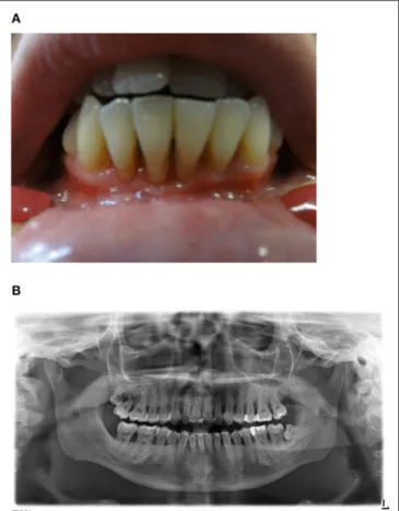 FIGURE 1 | (A) Clinical findings. Exposed root surfaces of the teeth 33–43 due to severe gingivitis and periodontitis in an age of 24 years