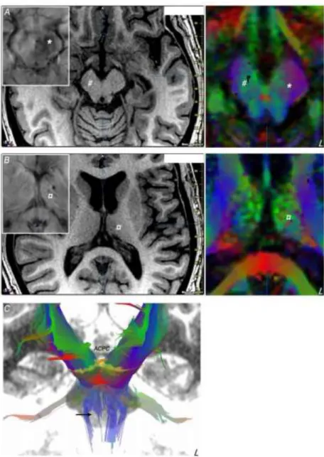 Figure 1: Mesencephalic (A) and thalamic (B) lesions showed on axial MRI slices (left,  T1-  weighted  image;  inlay  susceptibility  weighted  image;  right,  color-coded  fractional  anisotropy map) parallel to the anterior commissure - posterior commiss