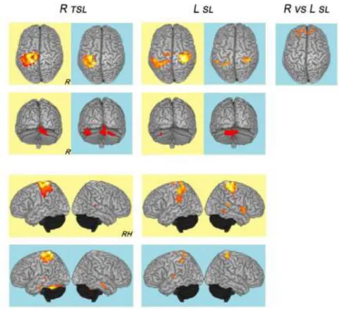 Figure 2: fMRI activations (superior, posterior and lateral views; right, R; R hemisphere,  RH)  following  motor  task  of  prono-supination  movements  of  the  forearm,  combined  with  alternating  hand  opening  and  closing,  before  (yellow)  and  a