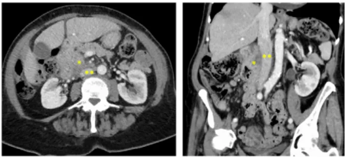Figure 2: (A) We performed a pancreaticoduodenectomy with en-bloc resection of a 3 cm² area of the anterior wall of the IVC (*)