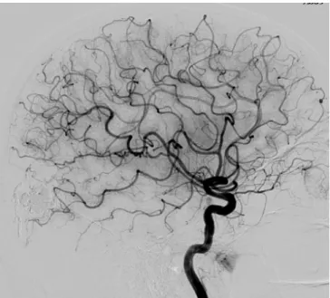 Figure  1- III-1 :  Représentation  du  réseau  artériel  cérébral  par  artériographie  carotidienne  droite