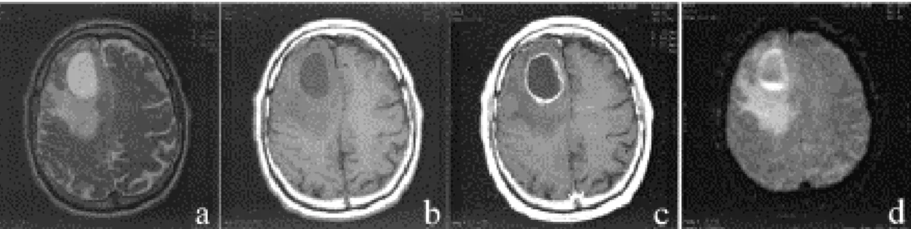 Figure  1- III-3 :  IRM  d’un  gliome  de  haut  grade  chez  un  patient  de  61  ans