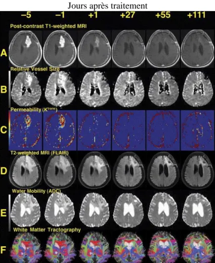 Figure 1- III-5 : Exemple clinique de caractérisation par IRM multiparamétrique de la réponse d’une  tumeur cérébrale à un traitement chimique