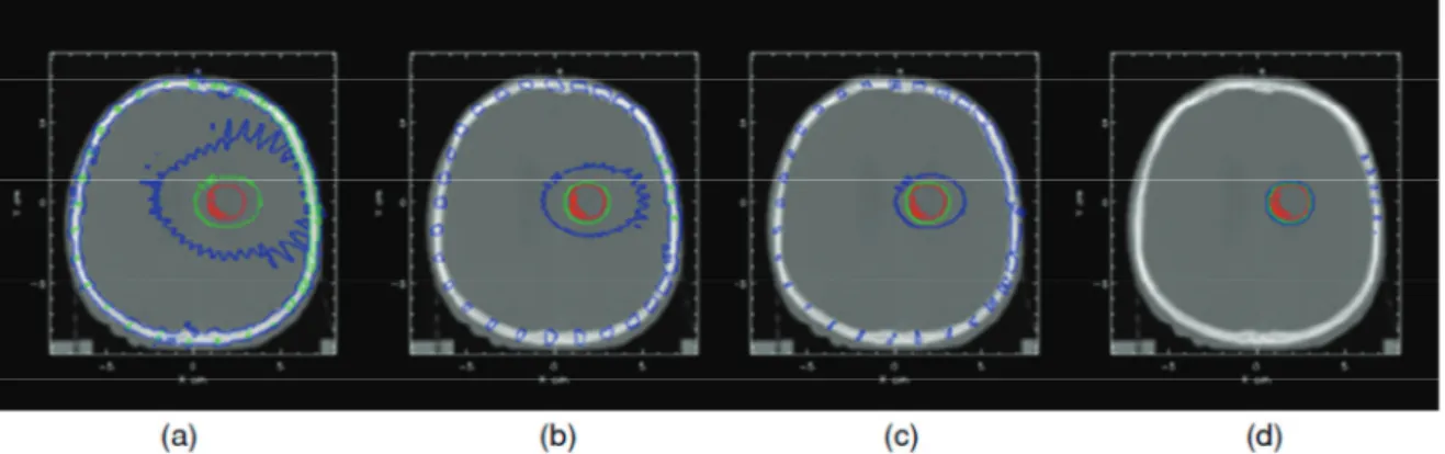 Figure 22: Distribution de dose lors d’une irradiation SSRT à 85 keV lors que la tumeur est charge avec: 0 5 10 et 20  mg/ml (respectivement figure a,b,c et d)