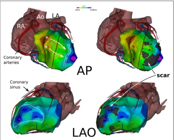 Figure 3.  Relationship between left ventricular (LV) scar and activation map in a patient with narrow QRS