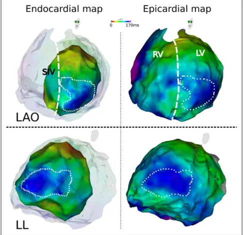 Figure 4.  Endocardial and epicardial acti- acti-vation map in nonspecific intraventricular  conduction delay (NICD) patient
