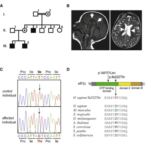 Figure 1. A Mutation of EIF2S3 /eIF2g Causes an Intellectual Disability Syndrome (A) Pedigree of the family