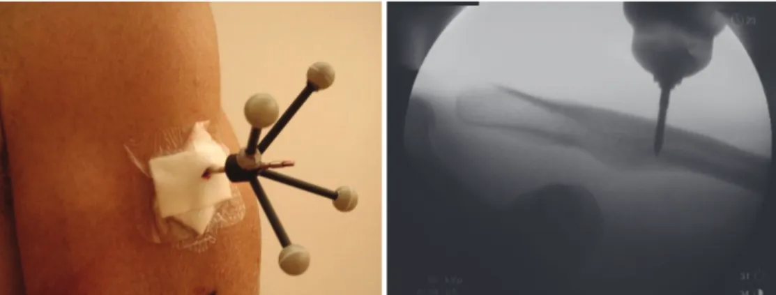 Figure 28 : Example of intracortical pin ((Ludewig et al., 2009) on the right) 