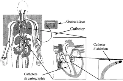 Figure 16: Ablation cardiaque par cathéter.