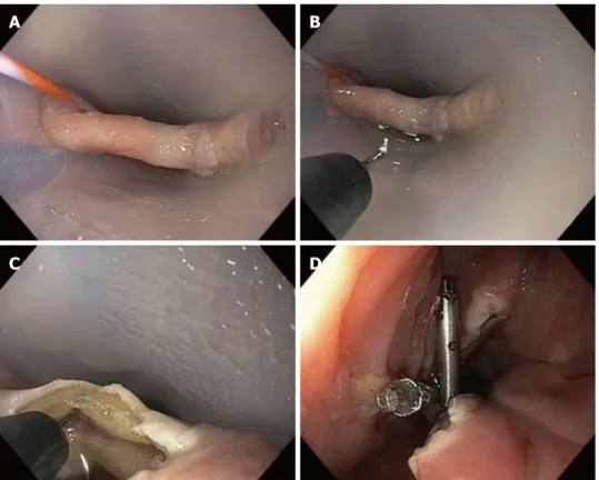 Figure  1  describes  the  endoscopic  procedure. 