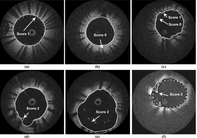 Figure 10 summarizes the configurations likely to occur, with  the exact location of the vessel boundary to be detected and the  associated risk for the patient