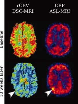 Figure 1.8.: rCBV (left) and CBF (right) maps from baseline (top row) and roughly 10 weeks later (bottom row) for a patient after post high-grade glioma resection with several stable follow-up exams