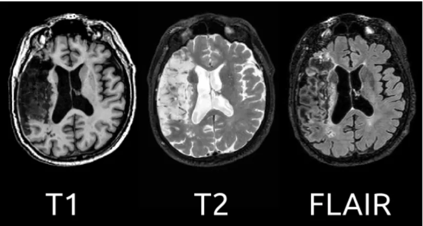 Figure 3.2: Illustration of different structural MRI images of a stroke patient.