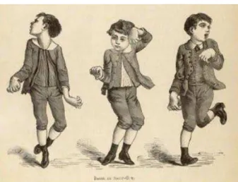 Figure 1 :  Dessin d’un jeune garçon atteint de Danse de Saint Guy (chorée)