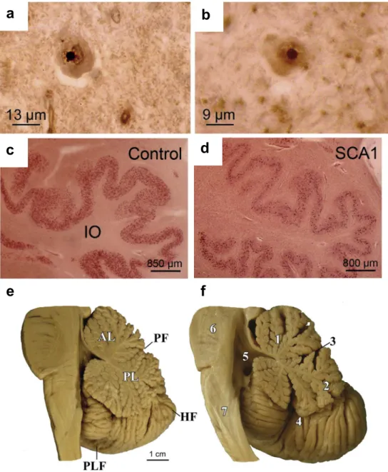 Figure 5: Neuropathological observations in SCA1. Neuronal intranuclear inclusion bodies  are found in the affected (a) inferior olive and (b) pontine nuclei