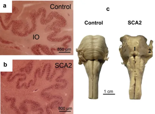 Figure 6: Neuropathological observations in SCA2. The inferior olives are degenerated in  (b) SCA2 compared to (a) healthy controls and (c) the brainstem is particularly atrophied in  SCA2 compared to healthy controls (Rüb et al., 2013)