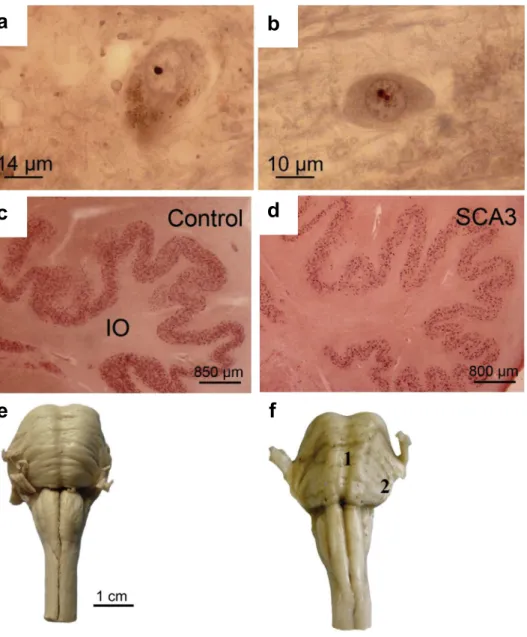 Figure 7: Neuropathological observations in SCA3. Neuronal intranuclear inclusion bodies  in the (a) substantia nigra and (b) pontine nuclei in SCA3