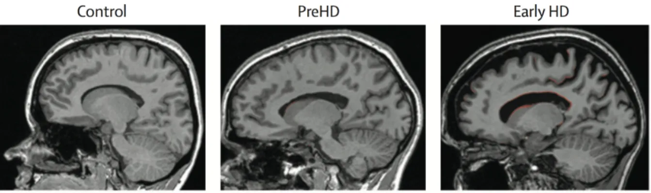 Figure 12: Brain boundary shift integral application in HD. The image shows regions of  atrophy  (red)  in  presymptomatic  individuals  (PreHD)  and  early  stage  HD  patients