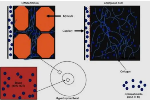 Figure 15. Schematic presentation of contrast media distribution in diffuse myocardial fibrosis  and contiguous chronic infarct
