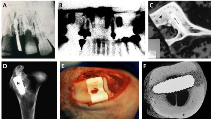 FIGURE 2. Different designs of nacre as Bone graft substitutes. A: Nacre incisor in the jaw of an Ancient Mayan individual