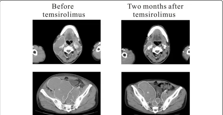 Figure 1 Computed tomography images of MCL. Areas of major lesions (surrounded by white broken lines) significantly regressed after two months of temsirolimus treatment.