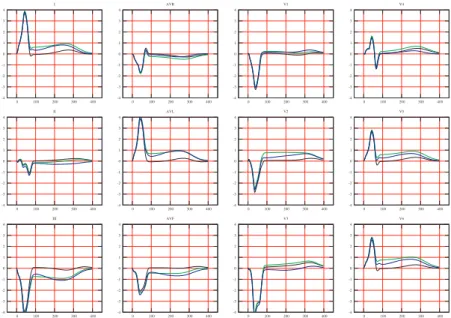 Figure 12: Simulated ECG for an infarction located in point P : green line represents the simulated reference ECG and blue line the ECG corresponding to the infarcted center found with the resolution of a genetic algorithm