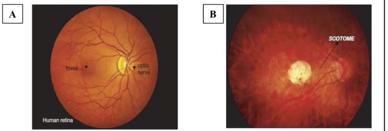 Figure 18 : Aspects de fond d’œil de présence de drüsens. (A) Rétine humaine normale (B) Forme atrophique (couasson, 2010).