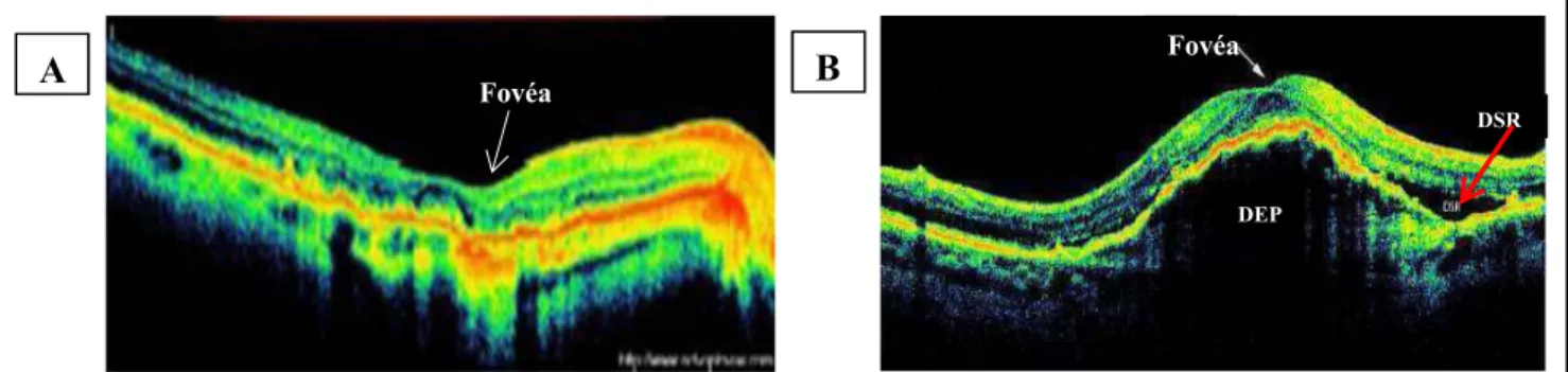 Figure 22 : La tomographie en cohérence optique (OCT) (A) d’un sujet sain et (B) d’un patient atteint de DMLA exsudative avec néovaisseaux occultes.