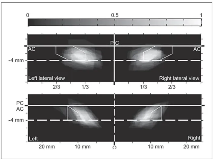 Figure 5. Density maps for the lateral (top) and front (bottom) views in Talairach’s stereotactic  reference  space