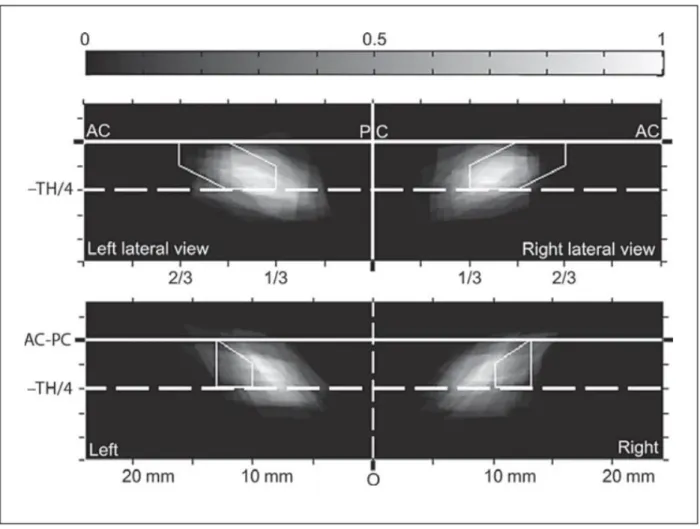 Figure  6.  Density  maps for  the  lateral  (top)  and  front  (bottom)  views  in  Benabid’s  stereotactic  reference  space