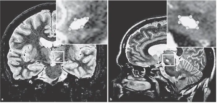 Figure  2.  Polygonal  simplification  of  STN  contouring  on  a  coronal  slice  (a,  native  MR  image)  and  a  sagittal  slice  (b,  image  reconstructed  from  the  coronal  image  set)