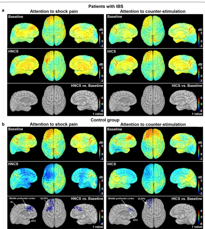 Fig. 5  Modulation of pain‑related high‑gamma oscillation sources by selective attention and heterotopic noxious counter‑stimulation (HNCS)