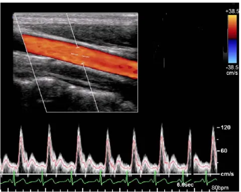Figure 5: Ultrasound velocity measurement of a young normal female patient, showing the natural variability from one cardiac cycle  to the next