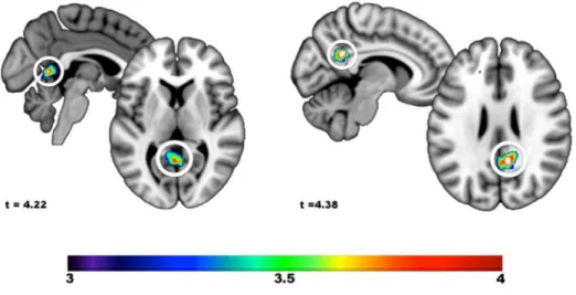 Figure 5. Changes in rCBF from pre-hypnosis to hypnosis positively associated with the increase in  self-reported hypnotic depth and individual hypnotic susceptibility scores