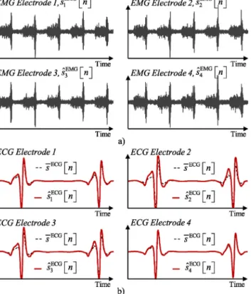 Fig 1. a) Example of obtained EMG simulated signals with K = 4 electrodes for r SIR = 13 dB