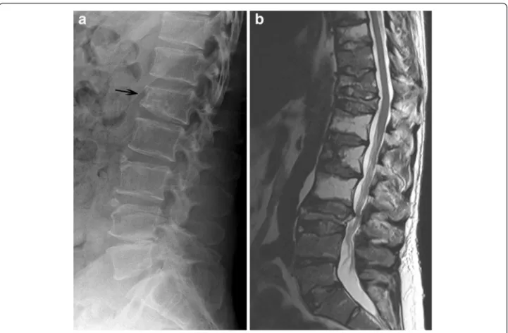Figure 6 Multiple Myeloma. A. A lateral radiograph of the lumbar spine shows diffuse osteopenia and a pathologic compression fracture of the L1 vertebral body (arrow)