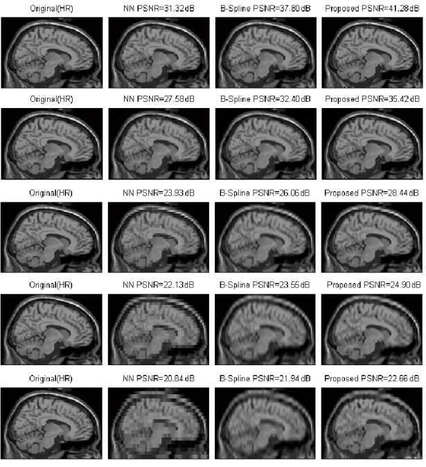 Figure 3. From up to down: Upsampling results of image datasets with different slice thickness  (1,3,5,7 and 9 mm)