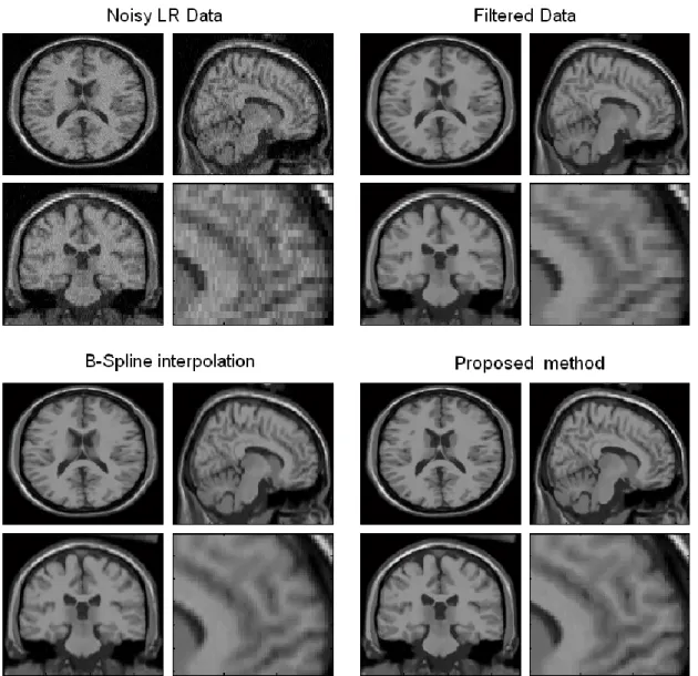 Figure 4. Results of noisy  data upsampling. The noisy (4% of Gaussian noise) LR data (voxel  resolution  =  1x1x3  mm 3 )  was  upsampled  to  have  a  1  mm 3   voxel  resolution  using  the  different  compared  methods