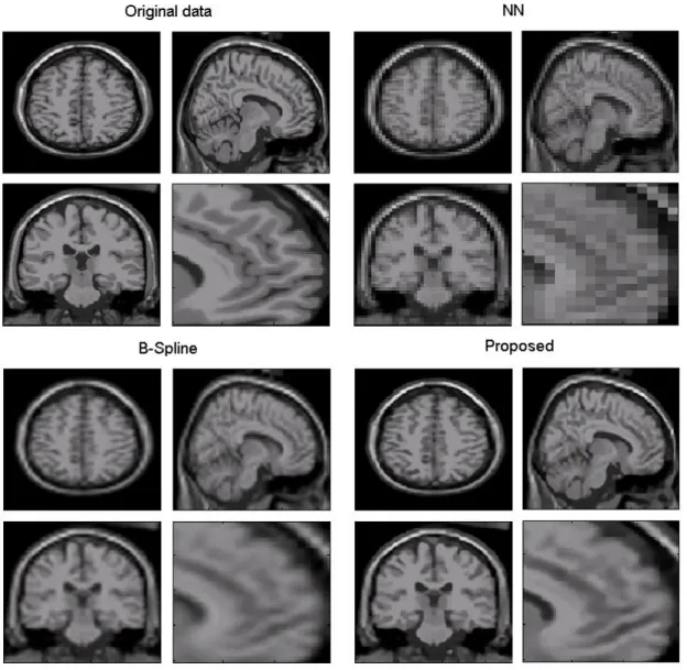 Figure 6. Results of isotropic voxel upsampling. LR data (voxel resolution = 4x4x4 mm 3 ) was up  sampled  to  have  a  1  mm 3   voxel  resolution  using  the  different  compared  methods