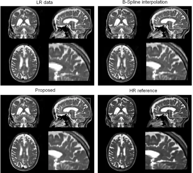 Figure 7. Results of real clinical data upsampling. LR data (voxel resolution =1x1x3 mm 3 ) was  upsampled  to  have  a  1  mm 3   voxel  resolution  using  the  B-Spline  and  proposed  methods