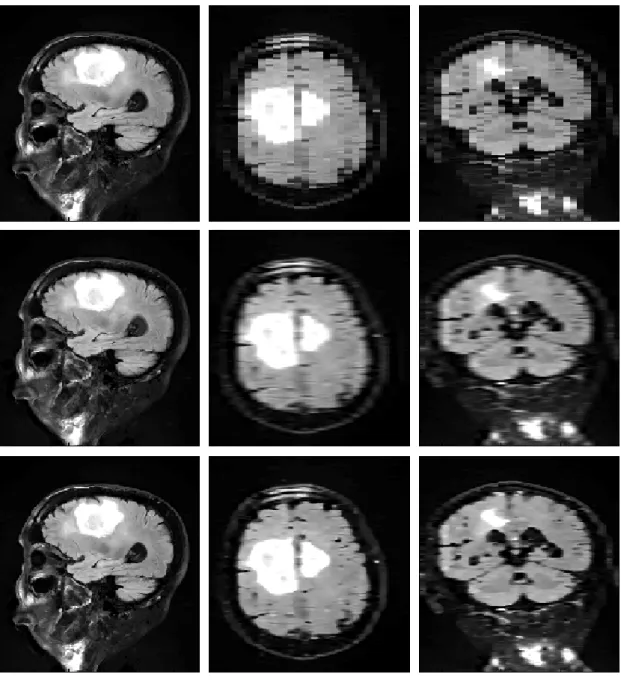 Figure 8. Results of real clinical data upsampling. Highly anisotropic LR data (voxel resolution =  0.81x0.81x6  mm 3 )  was  up  sampled  to  have  a  0.81x0.81x1  mm 3   voxel  resolution  using  the   B-Spline  and  proposed  methods