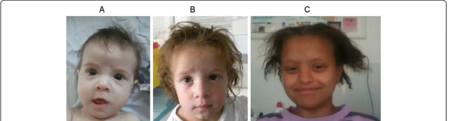 Figure 1 Clinical presentation of patients with mutations either in TTC37 (A at 8 month and B at 3 year) or SKIV2L (C).