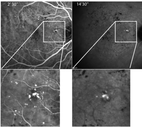 Figure 2. Comparison of early and late ICG staining patterns of microaneurysms and TCs (case 