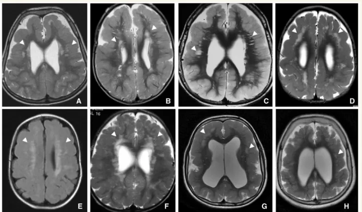 Figure 7 Representative axial T 2 images in GPR56 BFPP. These images demonstrate polymicrogyria in the frontoparietal regions bilaterally, as well as patchy bilateral signal change in the white matter, patchy (A, Patient II/1), (D, Patient IV/3), (E, Patie