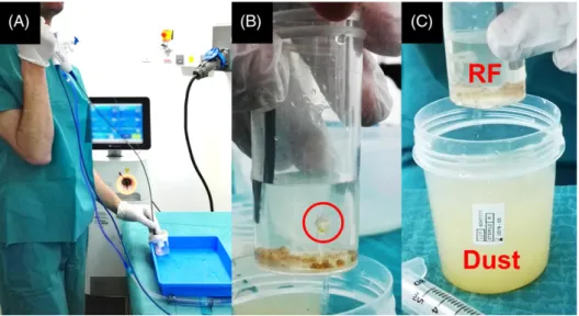 FIGURE 1 Holmium laser lithotripsy and sample preparation. A, Laser lithotripsy performed under direct visual control with a Lumenis P120H Holmium laser generator, a 200 μm laser fiber and a Lithovue fURS