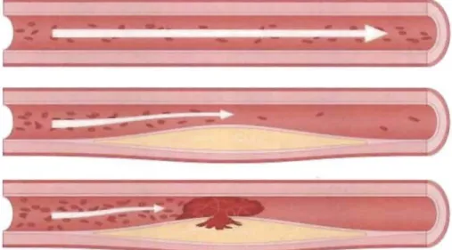 Figure  1.1  Représentation schématique simplifiée d' une artère saine (en  haut),  de  la formation  d'une plaque d'athérosclérose dans  la paroi  artérielle (au milieu)  et de la rupture d 'une plaque  d'athérosclérose suivie de la formation  d'un thromb