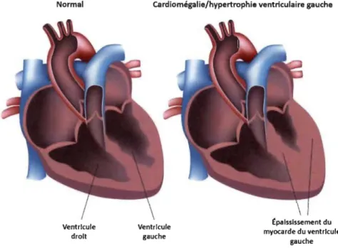 Figure  l.2 Représentation schématique simplifiée d'un cœur normal et d'un cœur hypertrophié  pathologique