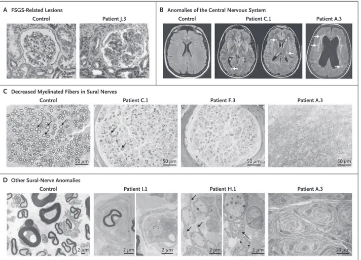 Figure 2. Features on Pathological Analysis and Neuroimaging in Selected Patients with Focal Segmental Glomerulosclerosis (FSGS)  and Charcot–Marie–Tooth Neuropathy.