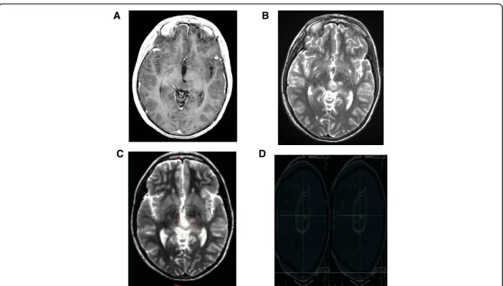 Figure 1 Conventional MR imaging, Target volume and Dosimetry of a Low-grade Glioma. A left thalamic low-grade oligodendroglioma in a 10 year-old boy after partial resection, without contrast enhancement